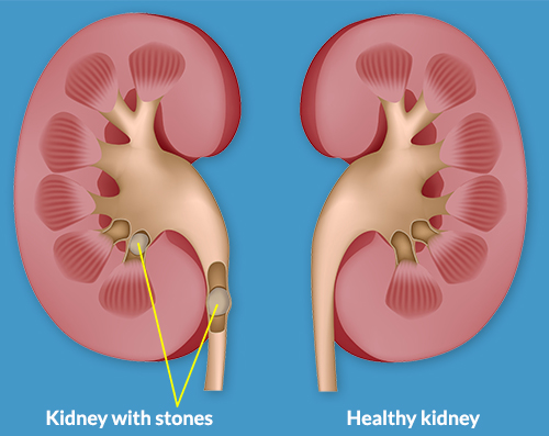 kidney-stones-illustration