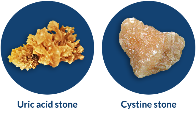 kidney_stones_types-02