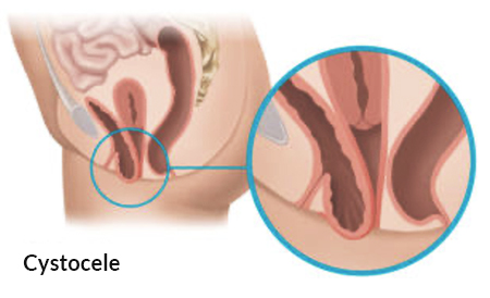 women-cystocele-illustration