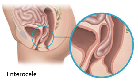 women-enterocele-illustration