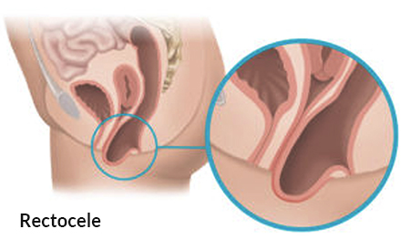women-rectocele-illustration